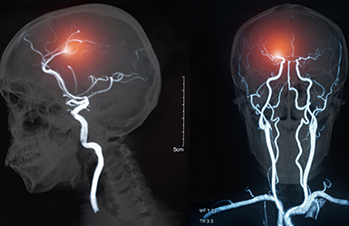 Stroke Unit 