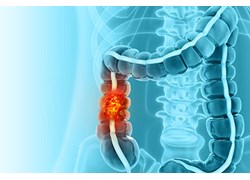 Why Colorectal Cancer Is Rising in Younger Adults, And What You Can Do About It