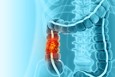 Why Colorectal Cancer Is Rising in Younger Adults, And What You Can Do About It